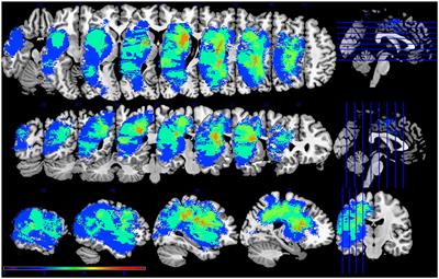 Hypoconnectivity of Resting-State Networks in Persons with Aphasia Compared with Healthy Age-Matched Adults